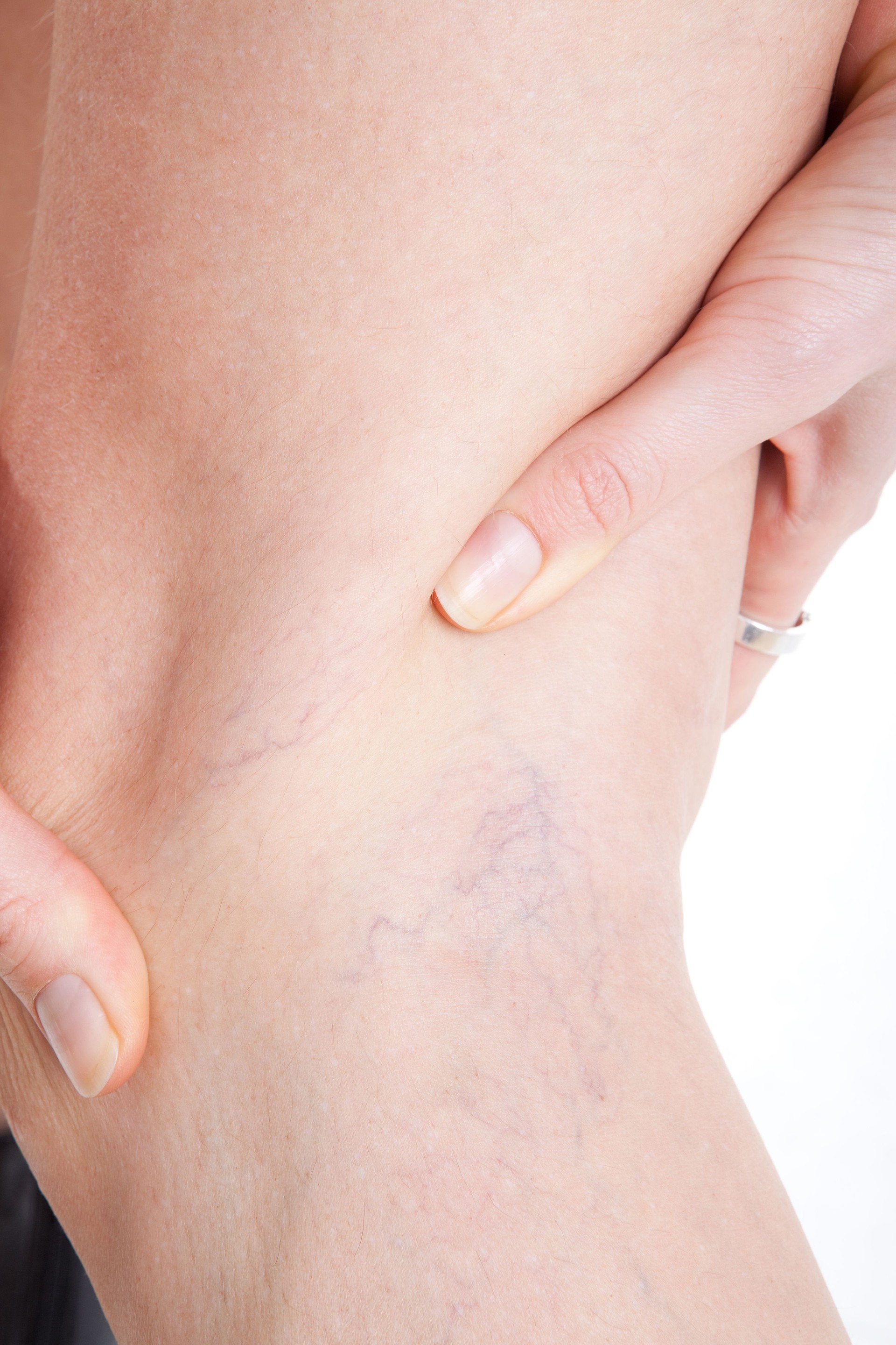 Varicose Vien on leg.